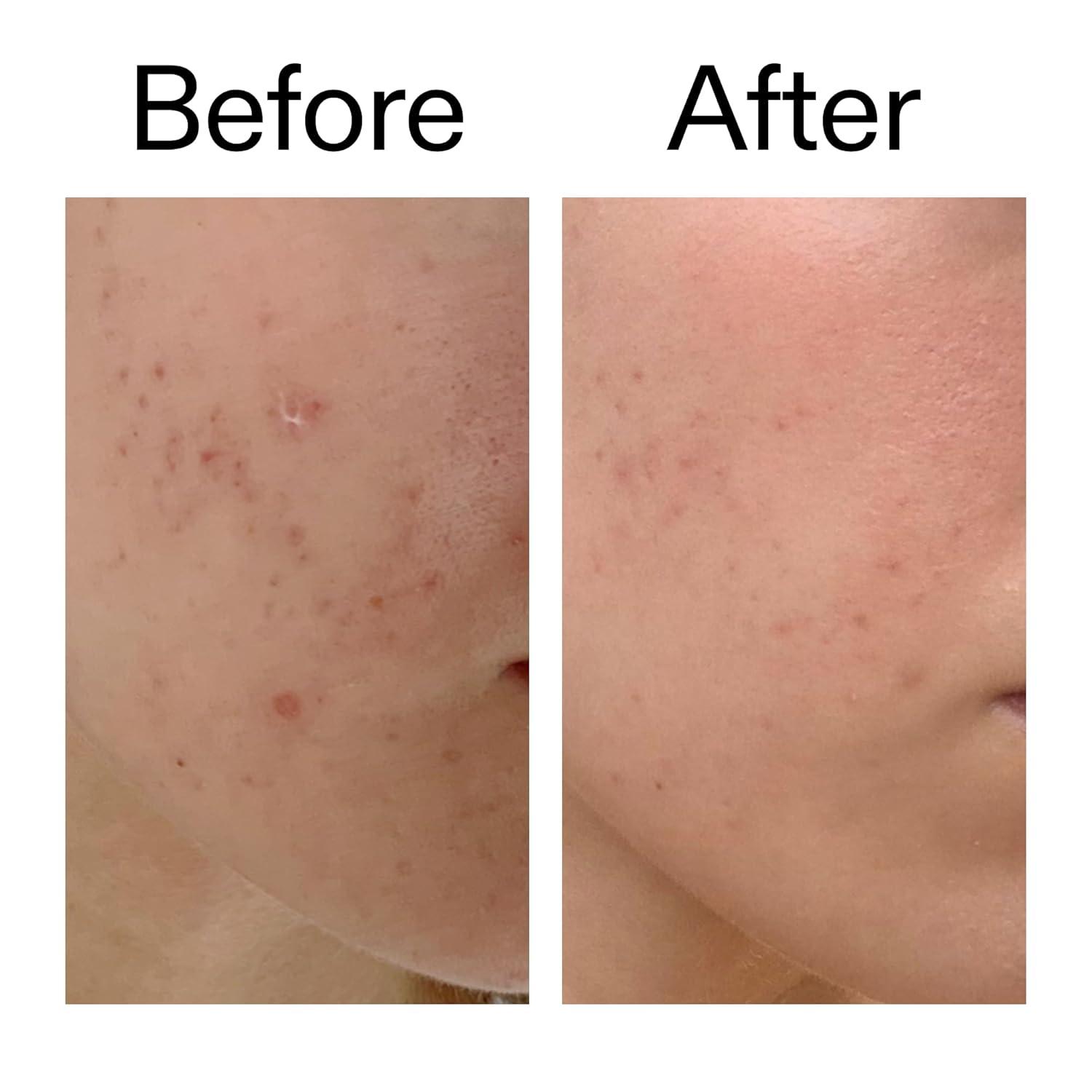 image:imageThe INKEY List Mandelic Acid Treatment Treats Hyperpigmentation Fades Acne Marks Fragrancefree Suitable For All Skin Types