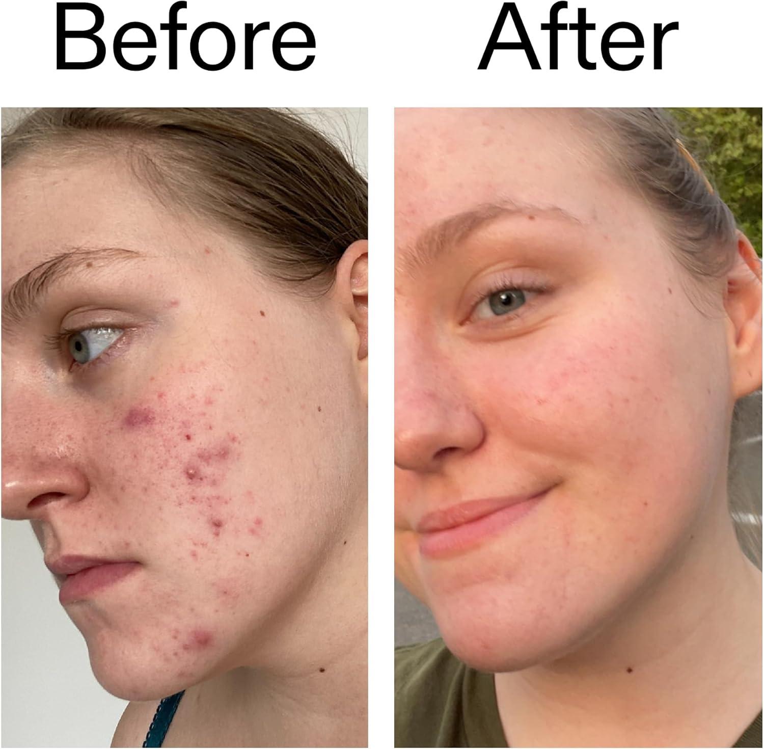 image:imageThe INKEY List 10 Glycolic Acid Toner 34 Fl Oz Includes Witch Hazel Pore Minimising Toner Brightens Skin Vegan Friendly Suitable for NormalOily Skin