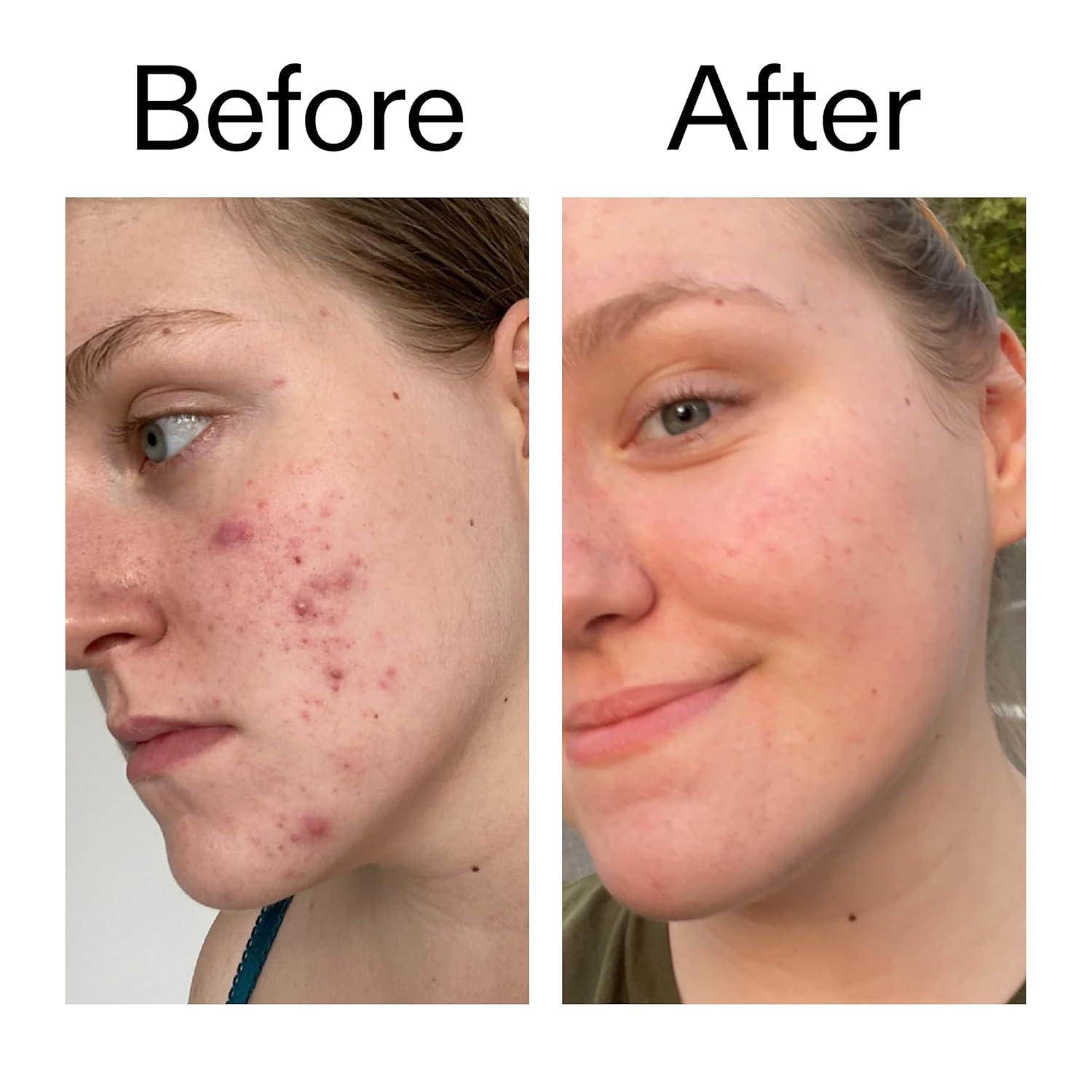 image:imageThe INKEY List 15 Vitamin C and EGF Serum 1 Fl Oz Reduces Hyperpigmentation Rejuvenating Skin Care Vegan Friendly Suitable For All Skin Types