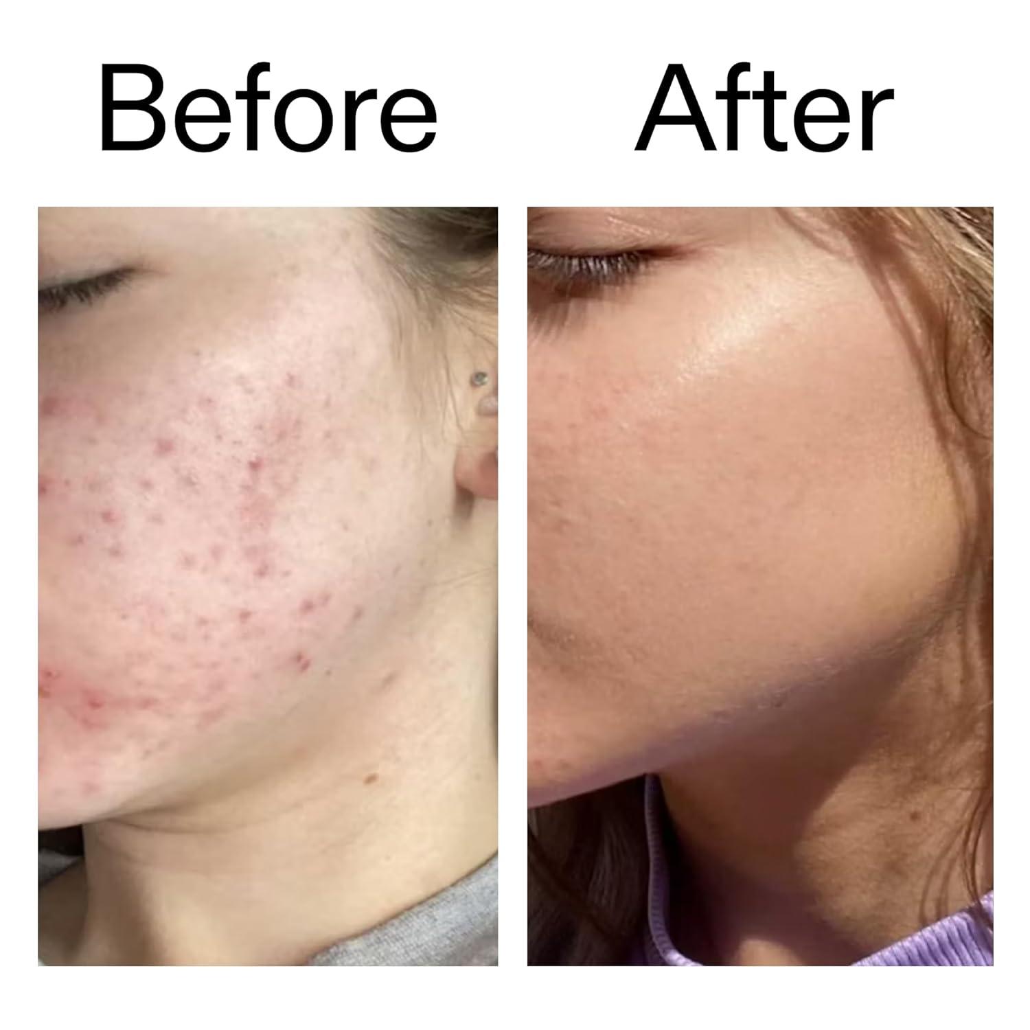 image:imageThe INKEY List Beta Hydroxy Acid BHA Serum Face Exfoliant for Normal Oily or Dry Skin Target Pores and Blackheads 101 fl oz