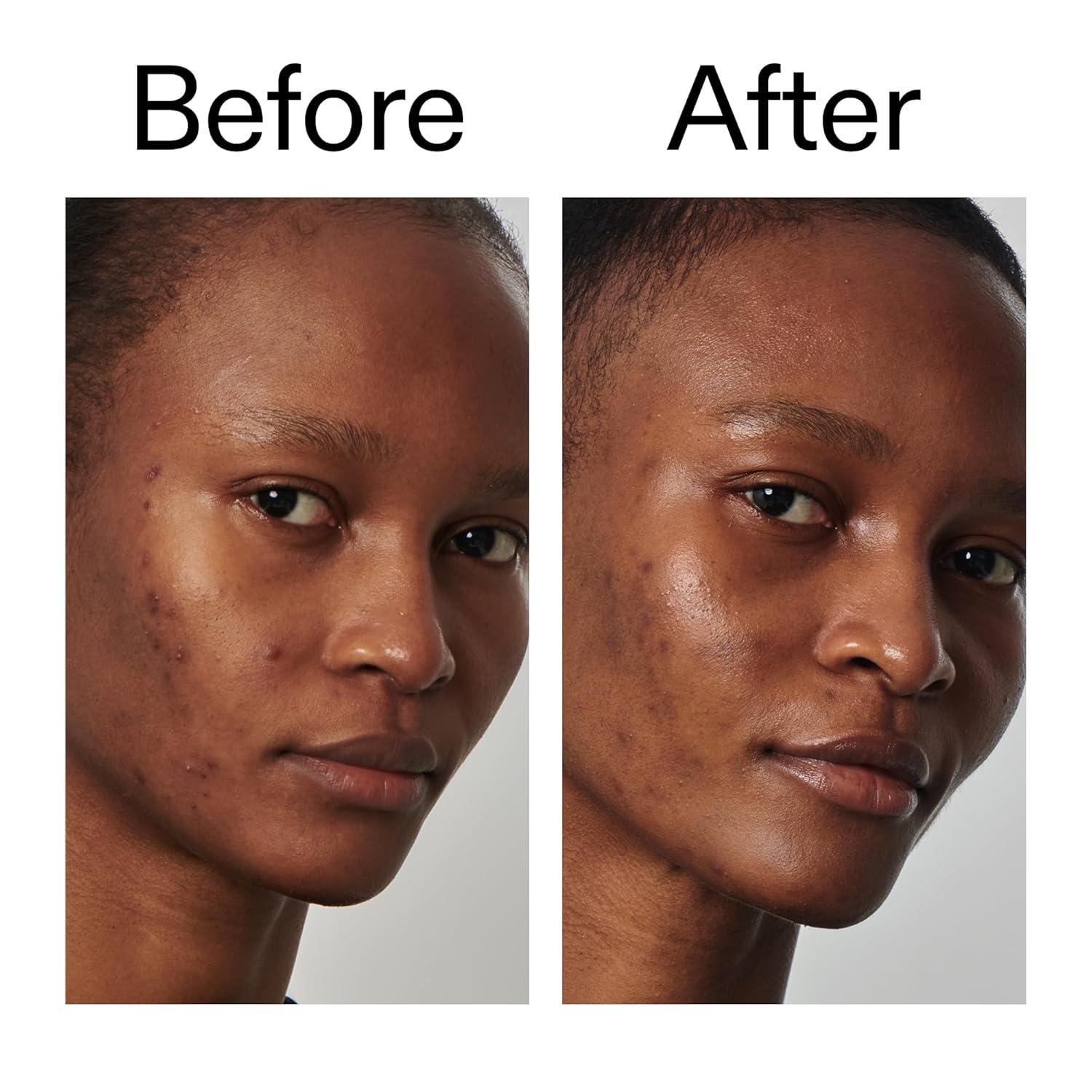 image:imageThe INKEY List SuperSolutions Niacinamide 20 Serum Helps with HealthyLooking Skin Texture Pores and Balancing Excess Oil Skin Barrier Protection 101 fl oz