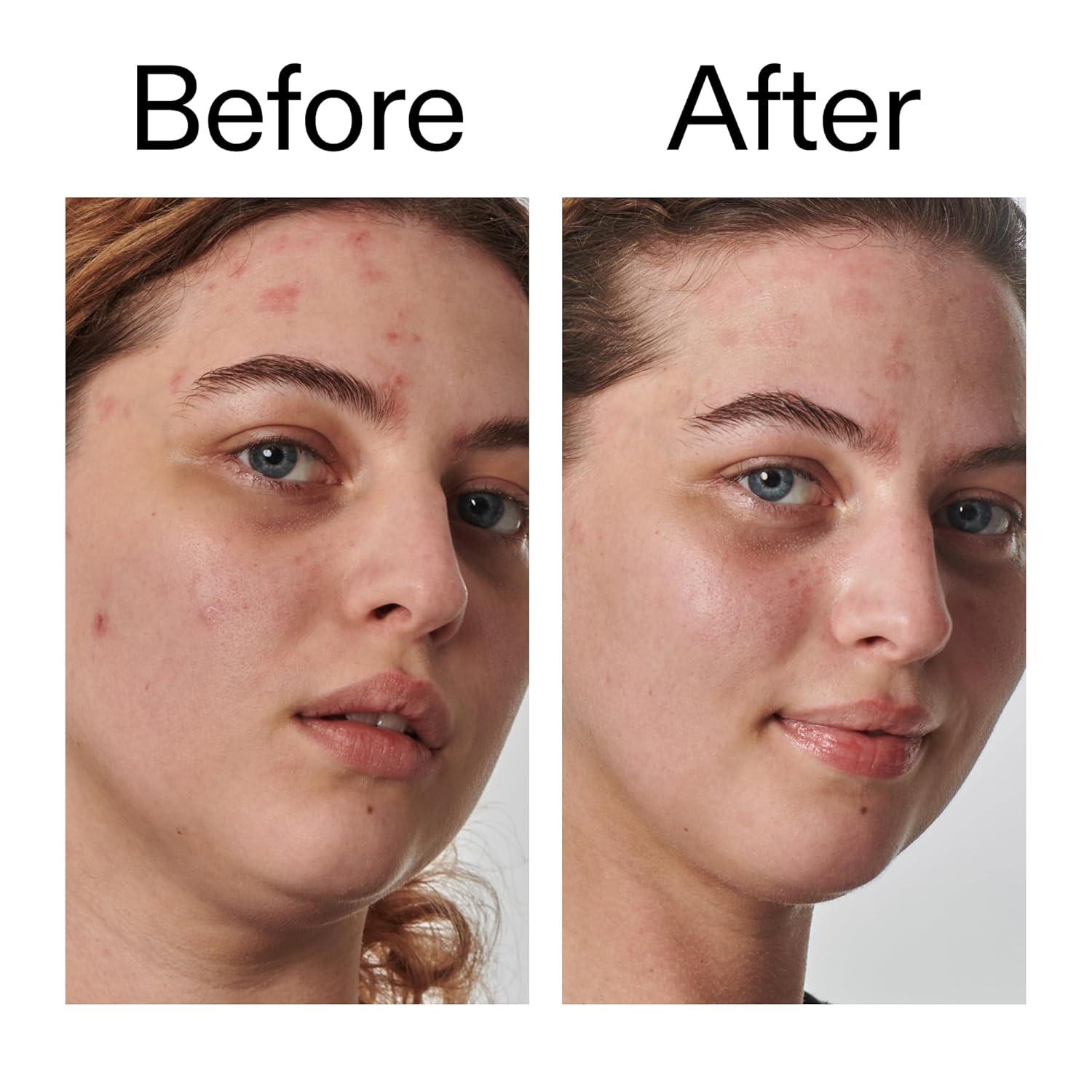 image:imageThe INKEY List SuperSolutions Urea 10 Moisturizer Quickly Helps to Hydrate Nourish and Soothe Dry Skin Gently Exfoliates Urea Moisturizer for Face 169 fl oz