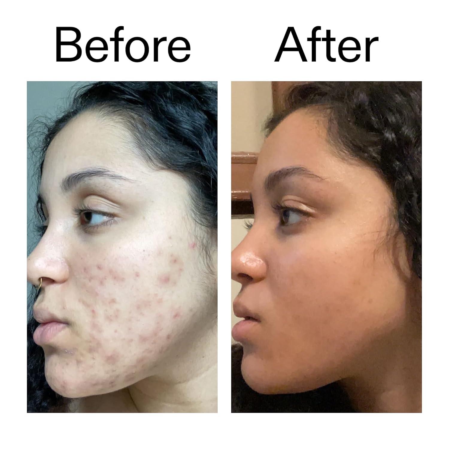 image:imageThe INKEY List Tranexamic Acid Serum Helps Reduce Appearance of Skin Discoloration Dark Spots and Uneven Patches HealthyLooking Skin Tone 1 fl oz